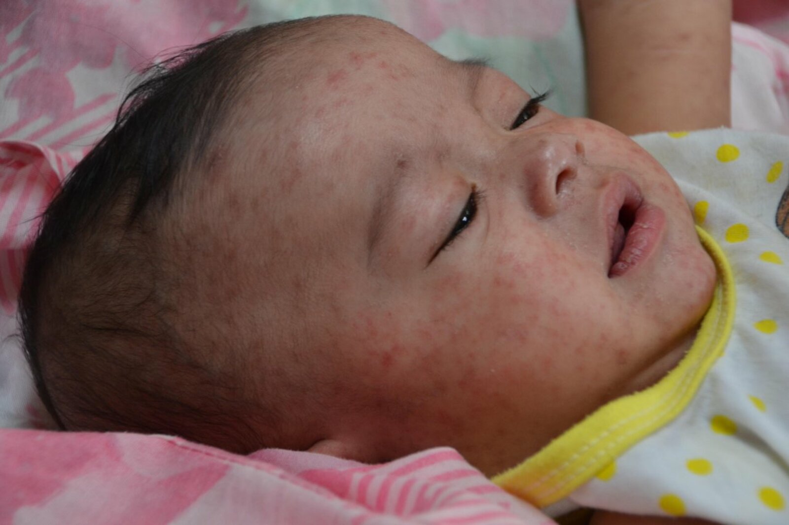 CDC Global - Measles is no joke, CC BY 2.0, https://commons.wikimedia.org/w/index.php?curid=76594880